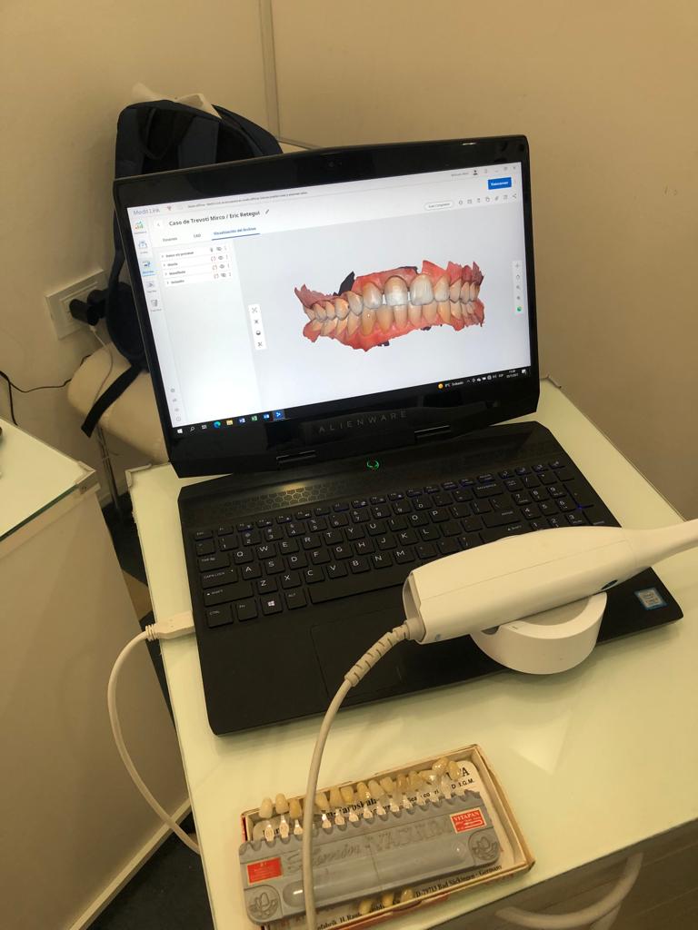 Escáner intraoral 3D de alta precisión para diagnóstico digital sin moldes molestos